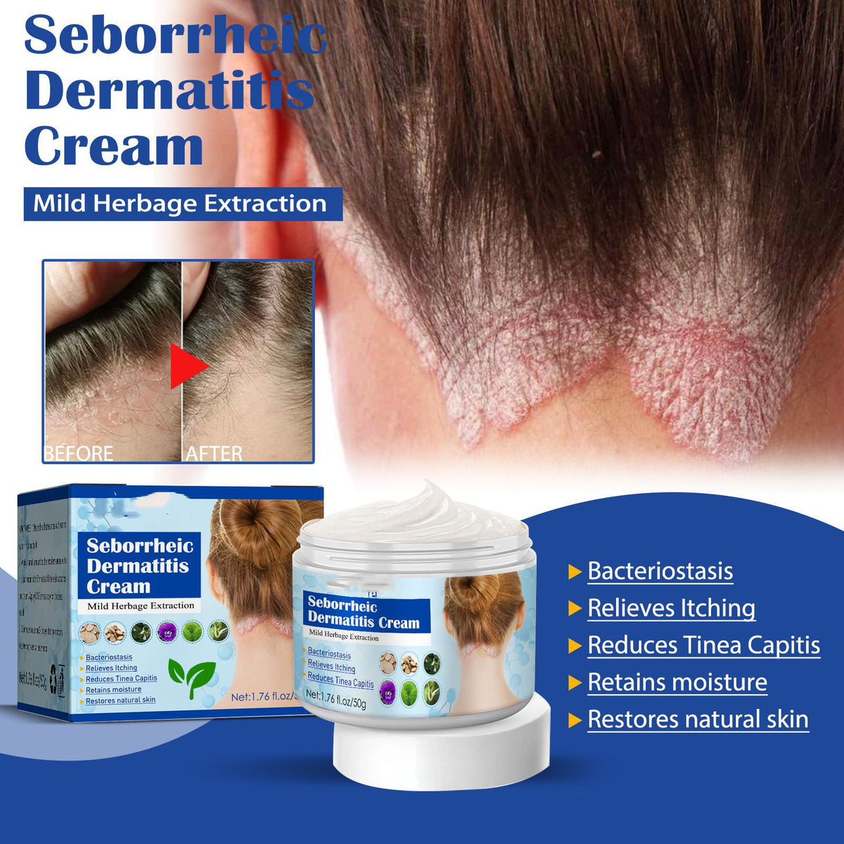 Seborrheic Skin Cream Head Acne Itching Repair